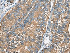 CEACAM8 / CD66b Antibody - Immunohistochemistry of paraffin-embedded Human gastric cancer tissue  using CEACAM8 Polyclonal Antibody at dilution of 1:30(×200)