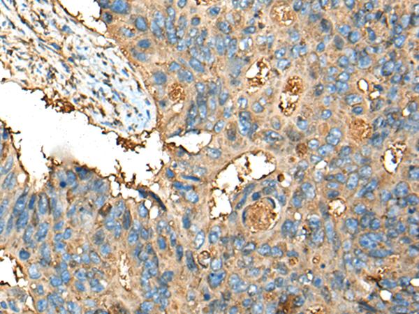 CEACAM8 / CD66b Antibody - Immunohistochemistry of paraffin-embedded Human colorectal cancer tissue  using CEACAM8 Polyclonal Antibody at dilution of 1:30(×200)