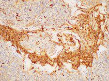 CEACAM8 / CD66b Antibody - Immunohistochemistry of paraffin-embedded Human tonsil using CEACAM8 Ployclonal Antibody at dilution of 1:200.