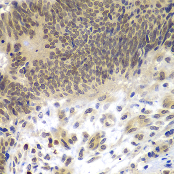 CEBPG / CEBP Gamma Antibody - Immunohistochemistry of paraffin-embedded human colon carcinoma tissue.