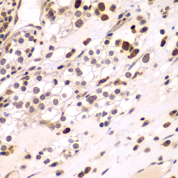CEBPG / CEBP Gamma Antibody - Immunohistochemistry of paraffin-embedded human kidney cancer tissue.