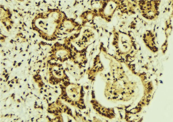 CEBPG / CEBP Gamma Antibody - 1:100 staining human breast carcinoma tissue by IHC-P. The sample was formaldehyde fixed and a heat mediated antigen retrieval step in citrate buffer was performed. The sample was then blocked and incubated with the antibody for 1.5 hours at 22°C. An HRP conjugated goat anti-rabbit antibody was used as the secondary.