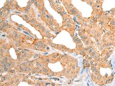 CECR1 Antibody - Immunohistochemistry of paraffin-embedded Human thyroid cancer tissue  using CECR1 Polyclonal Antibody at dilution of 1:40(×200)