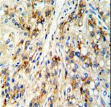 CECR5 Antibody - Formalin-fixed and paraffin-embedded human hepatocarcinoma reacted with CECR5 Antibody , which was peroxidase-conjugated to the secondary antibody, followed by DAB staining. This data demonstrates the use of this antibody for immunohistochemistry; clinical relevance has not been evaluated.