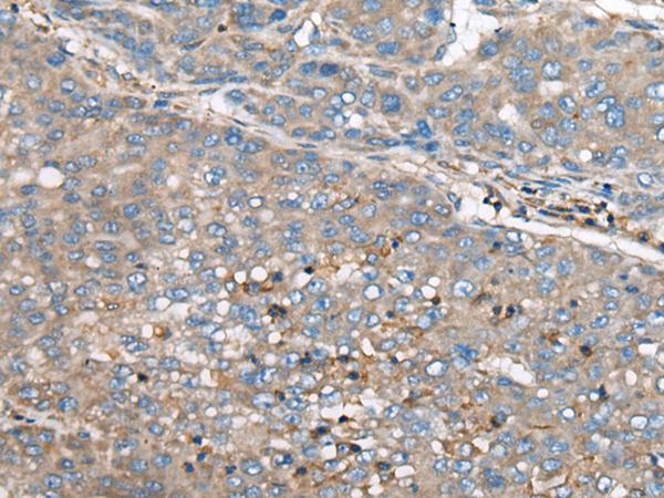 CED6 / GULP1 Antibody - Immunohistochemistry of paraffin-embedded Human liver cancer tissue  using GULP1 Polyclonal Antibody at dilution of 1:65(×200)