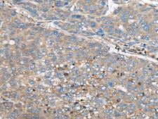CED6 / GULP1 Antibody - Immunohistochemistry of paraffin-embedded Human liver cancer tissue  using GULP1 Polyclonal Antibody at dilution of 1:65(×200)