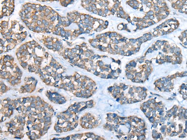 CED6 / GULP1 Antibody - Immunohistochemistry of paraffin-embedded Human esophagus cancer tissue  using GULP1 Polyclonal Antibody at dilution of 1:65(×200)