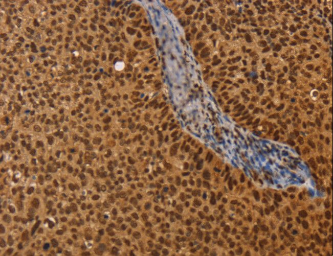 CEL / Carboxyl Ester Lipase Antibody - Immunohistochemistry of paraffin-embedded Human cervical cancer using CEL Polyclonal Antibody at dilution of 1:40.