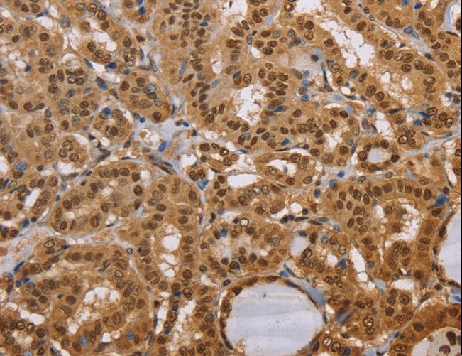CEL / Carboxyl Ester Lipase Antibody - Immunohistochemistry of paraffin-embedded Human thyroid cancer using CEL Polyclonal Antibody at dilution of 1:40.