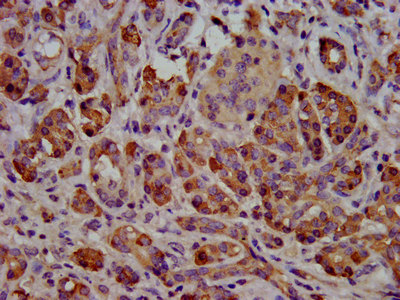 CEL / Carboxyl Ester Lipase Antibody - Immunohistochemistry image at a dilution of 1:500 and staining in paraffin-embedded human pancreatic cancer performed on a Leica BondTM system. After dewaxing and hydration, antigen retrieval was mediated by high pressure in a citrate buffer (pH 6.0) . Section was blocked with 10% normal goat serum 30min at RT. Then primary antibody (1% BSA) was incubated at 4 °C overnight. The primary is detected by a biotinylated secondary antibody and visualized using an HRP conjugated SP system.