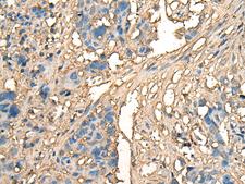 CELA1 / Pancreatic Elastase 1 Antibody - Immunohistochemistry of paraffin-embedded Human lung cancer tissue  using CELA1 Polyclonal Antibody at dilution of 1:70(×200)