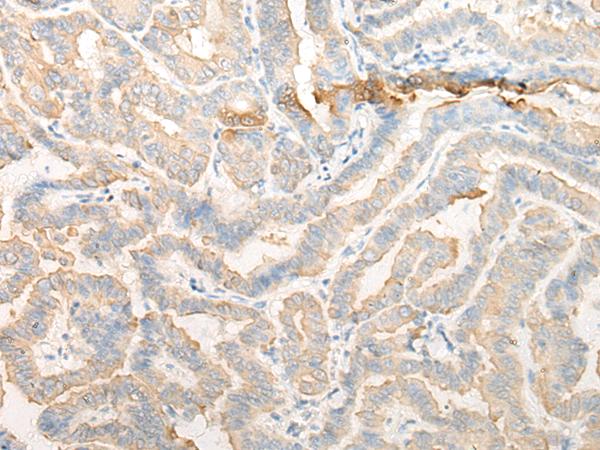 CELA3A / ELA3 Antibody - Immunohistochemistry of paraffin-embedded Human thyroid cancer tissue  using CELA3A Polyclonal Antibody at dilution of 1:25(×200)