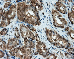 CELF1 / CUGBP1 Antibody - IHC of paraffin-embedded Carcinoma of prostate tissue using anti-CUGBP1 mouse monoclonal antibody. (Dilution 1:50).