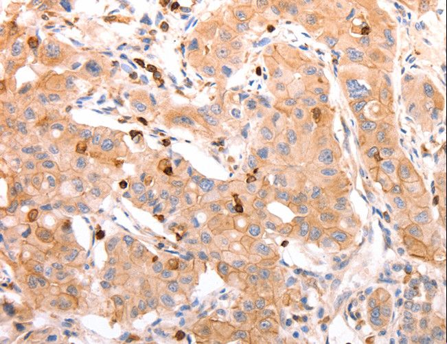 CELSR2 Antibody - Immunohistochemistry of paraffin-embedded Human lung cancer using CELSR2 Polyclonal Antibody at dilution of 1:50.