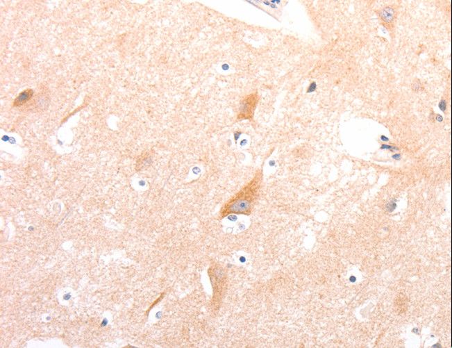 CELSR2 Antibody - Immunohistochemistry of paraffin-embedded Human colon cancer using CELSR2 Polyclonal Antibody at dilution of 1:50.