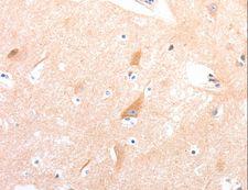 CELSR2 Antibody - Immunohistochemistry of paraffin-embedded Human colon cancer using CELSR2 Polyclonal Antibody at dilution of 1:50.
