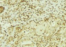CEMIP / KIAA1199 Antibody - 1:100 staining human breast carcinoma tissue by IHC-P. The sample was formaldehyde fixed and a heat mediated antigen retrieval step in citrate buffer was performed. The sample was then blocked and incubated with the antibody for 1.5 hours at 22°C. An HRP conjugated goat anti-rabbit antibody was used as the secondary.