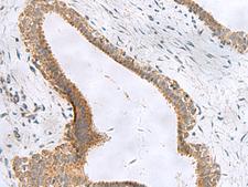 CEMIP / KIAA1199 Antibody - Immunohistochemistry of paraffin-embedded Human breast cancer tissue  using CEMIP Polyclonal Antibody at dilution of 1:120(×200)