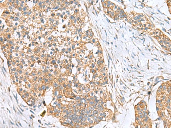 CEMIP / KIAA1199 Antibody - Immunohistochemistry of paraffin-embedded Human esophagus cancer tissue  using CEMIP Polyclonal Antibody at dilution of 1:120(×200)