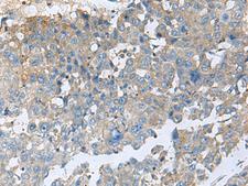 CEMIP / KIAA1199 Antibody - Immunohistochemistry of paraffin-embedded Human liver cancer tissue  using CEMIP Polyclonal Antibody at dilution of 1:60(×200)