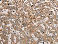 CEND1 Antibody - Immunohistochemistry of paraffin-embedded Human liver cancer tissue  using CEND1 Polyclonal Antibody at dilution of 1:50(×200)