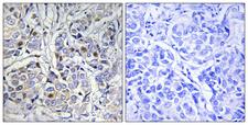CENPA / CENP-A Antibody - Immunohistochemistry analysis of paraffin-embedded human breast carcinoma tissue, using Centromeric Protein A Antibody. The picture on the right is blocked with the synthesized peptide.