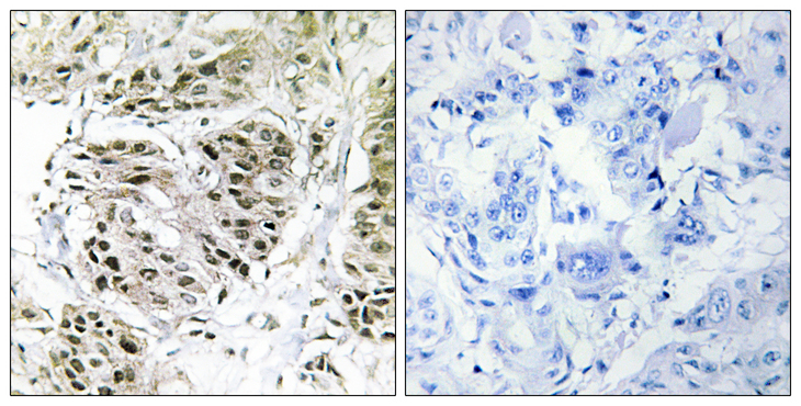 CENPA / CENP-A Antibody - Immunohistochemistry analysis of paraffin-embedded human breast carcinoma, using CENPA Antibody. The picture on the right is blocked with the synthesized peptide.