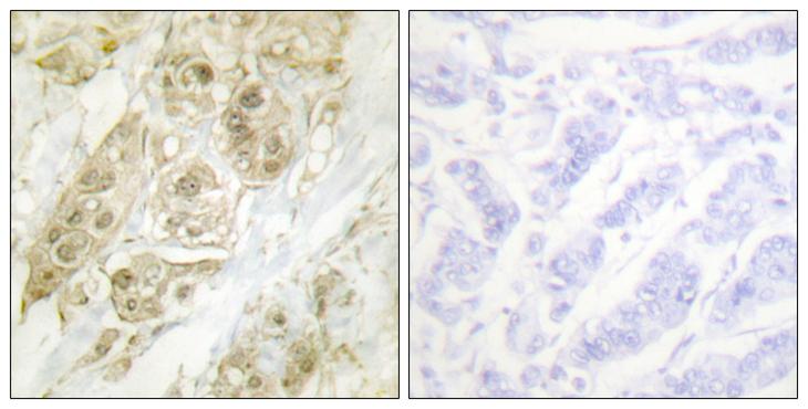 CENPA / CENP-A Antibody - Forskolin + - Immunohistochemistry analysis of paraffin-embedded human breast carcinoma tissue using Centromeric Protein A antibody.