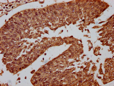CENPA / CENP-A Antibody - Immunohistochemistry Dilution at 1:10 and staining in paraffin-embedded human cervical cancer performed on a Leica BondTM system. After dewaxing and hydration, antigen retrieval was mediated by high pressure in a citrate buffer (pH 6.0). Section was blocked with 10% normal Goat serum 30min at RT. Then primary antibody (1% BSA) was incubated at 4°C overnight. The primary is detected by a biotinylated Secondary antibody and visualized using an HRP conjugated SP system.