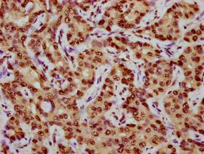 CENPA / CENP-A Antibody - Immunohistochemistry Dilution at 1:10 and staining in paraffin-embedded human liver cancer performed on a Leica BondTM system. After dewaxing and hydration, antigen retrieval was mediated by high pressure in a citrate buffer (pH 6.0). Section was blocked with 10% normal Goat serum 30min at RT. Then primary antibody (1% BSA) was incubated at 4°C overnight. The primary is detected by a biotinylated Secondary antibody and visualized using an HRP conjugated SP system.