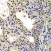 CENPC / CENP-C Antibody - Immunohistochemistry of paraffin-embedded human oophoroma tissue.