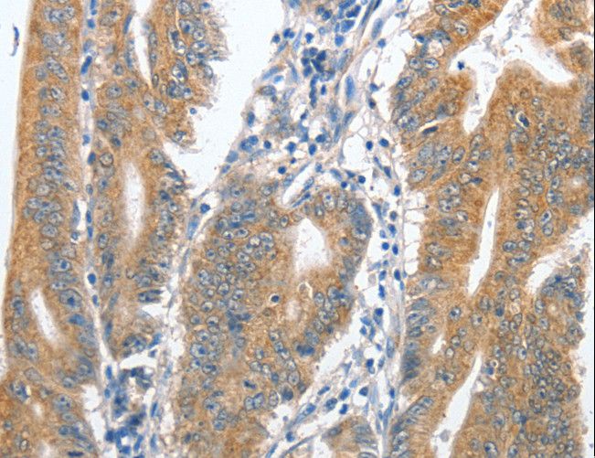 CENPC / CENP-C Antibody - Immunohistochemistry of paraffin-embedded Human colon cancer using CENPC Polyclonal Antibody at dilution of 1:70.