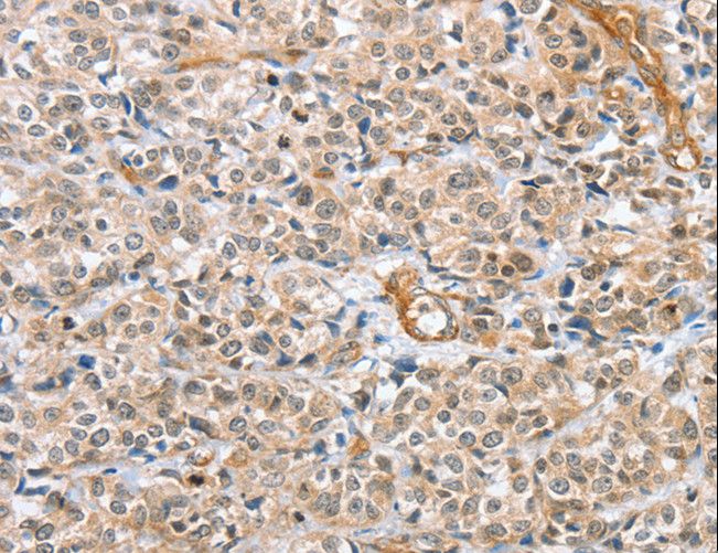 CENPC / CENP-C Antibody - Immunohistochemistry of paraffin-embedded Human esophagus cancer using CENPC Polyclonal Antibody at dilution of 1:70.