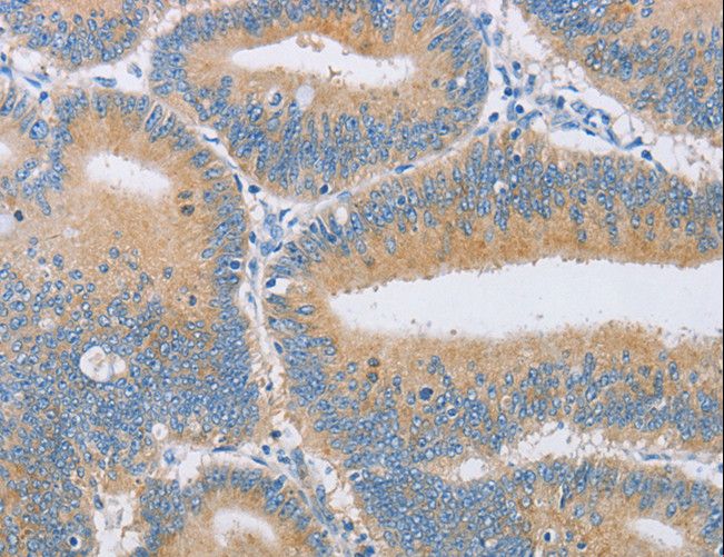 CENPE Antibody - Immunohistochemistry of paraffin-embedded Human colon cancer using CENPE Polyclonal Antibody at dilution of 1:50.