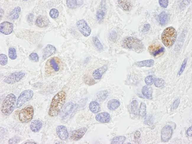 CENPF / CENP-F Antibody - Detection of Human CENP-F/Mitosin by Immunohistochemistry. Sample: FFPE section of human Ewing sarcoma. Antibody: Affinity purified rabbit anti-CENP-F/Mitosin used at a dilution of 1:500.