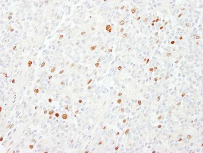 CENPF / CENP-F Antibody - Detection of Human CENP-F/Mitosin by Immunohistochemistry. Sample: FFPE section of human Ewing sarcoma. Antibody: Affinity purified rabbit anti-CENP-F/Mitosin used at a dilution of 1:200 (1 ug/ml).