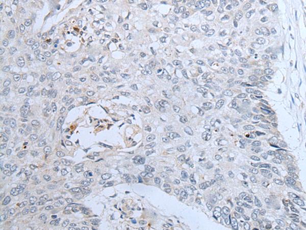 CENPF / CENP-F Antibody - Immunohistochemistry of paraffin-embedded Human lung cancer tissue  using CENPF Polyclonal Antibody at dilution of 1:60(×200)