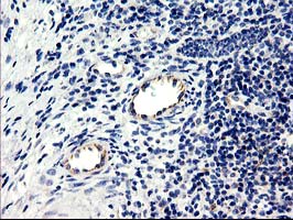 CENPH / CENP-H Antibody - IHC of paraffin-embedded Carcinoma of Human bladder tissue using anti-CENPH mouse monoclonal antibody.