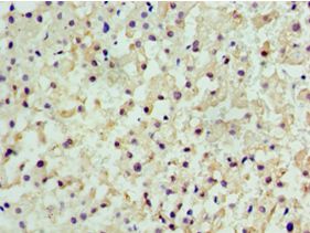 CENPQ Antibody - Immunohistochemistry of paraffin-embedded human liver cancer using antibody at 1:100 dilution.