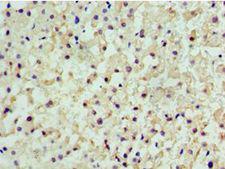 CENPQ Antibody - Immunohistochemistry of paraffin-embedded human liver cancer using antibody at 1:100 dilution.