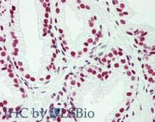 CENPU / MLF1IP Antibody - Immunohistochemistry of rabbit anti-Pogz antibody. Tissue: prostate. Fixation: formalin fixed paraffin embedded. Antigen retrieval: not required. Primary antibody: Anti-Pogz at 5 µg/mL for 1 h at RT. Secondary antibody: Peroxidase rabbit secondary antibody at 1:10,000 for 45 min at RT. Staining: Pogz as precipitated red signal with hematoxylin purple nuclear counterstain.