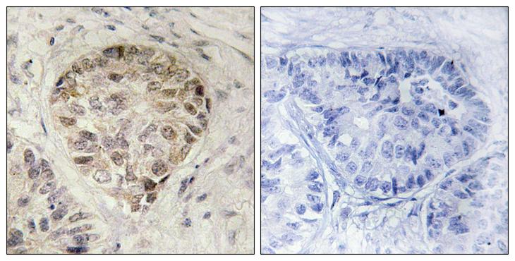 CENTB1 / ACAP1 Antibody - P-peptide - + Immunohistochemistry analysis of paraffin-embedded human lung carcinoma tissue, using Centaurin-ß1 (Phospho-Ser554) antibody.