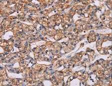 CENTD2 / ARAP1 Antibody - Immunohistochemistry of paraffin-embedded Human prostate cancer using ARAP1 Polyclonal Antibody at dilution of 1:40.