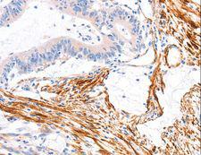 CENTD2 / ARAP1 Antibody - Immunohistochemistry of paraffin-embedded Human colon cancer using ARAP1 Polyclonal Antibody at dilution of 1:80.