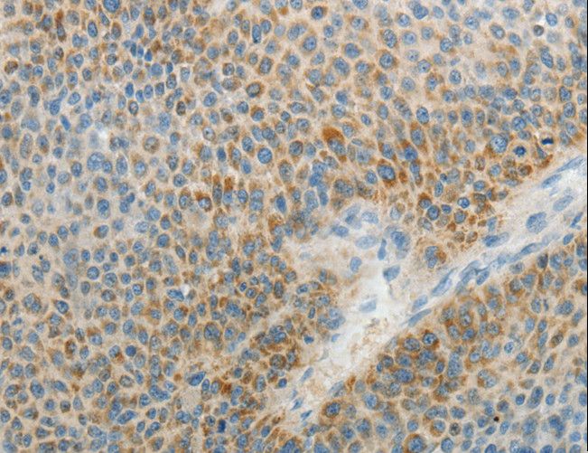 CENTG2 / AGAP1 Antibody - Immunohistochemistry of paraffin-embedded Human liver cancer using AGAP1 Polyclonal Antibody at dilution of 1:25.