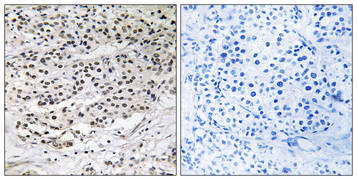 CEP131 / AZI1 Antibody - Immunohistochemistry analysis of paraffin-embedded human breast carcinoma tissue, using AZI1 Antibody. The picture on the right is blocked with the synthesized peptide.