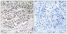 CEP131 / AZI1 Antibody - Peptide - + Immunohistochemistry analysis of paraffin-embedded human breast carcinoma tissue using AZI1 antibody.
