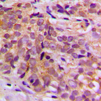 CEP170 Antibody - Immunohistochemical analysis of CEP170 staining in human breast cancer formalin fixed paraffin embedded tissue section. The section was pre-treated using heat mediated antigen retrieval with sodium citrate buffer (pH 6.0). The section was then incubated with the antibody at room temperature and detected using an HRP conjugated compact polymer system. DAB was used as the chromogen. The section was then counterstained with hematoxylin and mounted with DPX. w