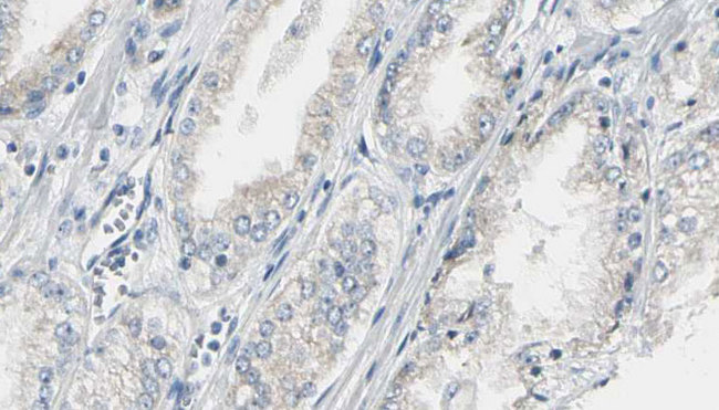 CEP170 Antibody - 1:100 staining human prostate tissue by IHC-P. The sample was formaldehyde fixed and a heat mediated antigen retrieval step in citrate buffer was performed. The sample was then blocked and incubated with the antibody for 1.5 hours at 22°C. An HRP conjugated goat anti-rabbit antibody was used as the secondary.