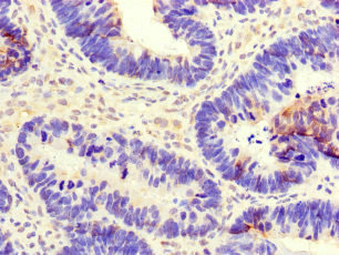 CEP290 Antibody - Immunohistochemistry of paraffin-embedded human ovarian cancer at dilution of 1:100